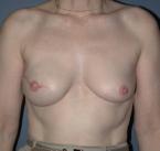 breast_enhancement25.jpg