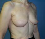 breast_enhancement31.jpg