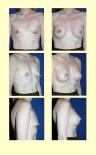 breast_enhancement45.jpg